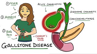 Gallstone Disease  Acute Cholecystitis vs Cholelithiasis vs Choledocholithiasis vs Cholangitis [upl. by Emmalynn734]