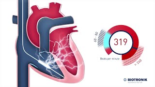 British Heart Foundation  Your guide to ICD and pacemaker implantation [upl. by Janetta854]