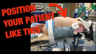 Robotic Right Colectomy Patient Positioning 101 [upl. by Llemej]