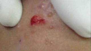 Treatment of Molluscum Contagiosumwmv [upl. by Hsur931]