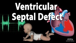 Ventricular Septal Defect Animation [upl. by Porett]