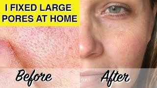 DIY LARGE PORES TREATMENT At Home Glycolic Acid Peel Dramatically Reduces Pores amp Wrinkles [upl. by Akinihs429]