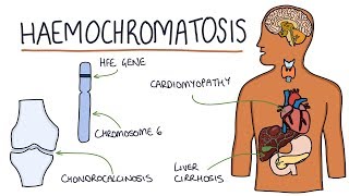 Understanding Haemochromatosis [upl. by Ainot]