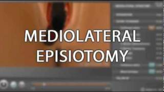 Trailer  Chapter on Episiotomy [upl. by Key407]