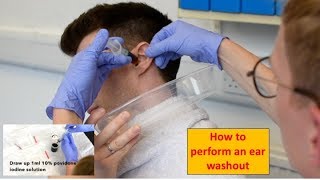 How to Perform an Ear Washout irrigation  ENTOtolaryngology Skills [upl. by Lisette]