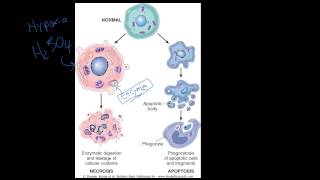 4  Introduction to Pathology  Necrosis vs Apoptosis [upl. by Akimas]