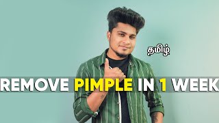 HOW TO REMOVE PIMPLE PERMANENTLY  IN TAMIL  SARAN LIFESTYLE [upl. by Akimert758]