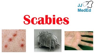 Scabies Skin Condition  What Is It Classic vs Crusted Types Signs amp Symptoms Treatment [upl. by Aihsemot]