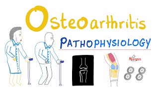 Osteoarthritis OA  Pathophysiology  Rheumatology Series [upl. by Luci]