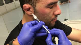 Treating Cauliflower Ear J2LATOS Long Beach [upl. by Airun504]