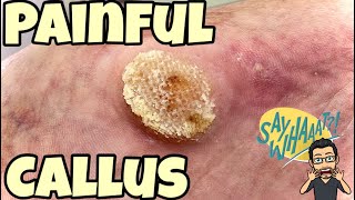 SATISFYING CALLUS REMOVAL FROM FEET [upl. by Ohcamac]