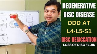 Disc Degeneration Disease DDD Treatment for Degenerative Disc Disease Lumbar Disc L4L5 L5S1 [upl. by Odyssey]