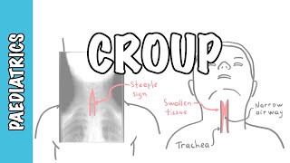 Pediatricians Explain Croup Symptoms and Sounds [upl. by Etteroma]