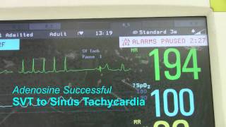 Ventricular Rhythms  EKG Interpretation  LevelUpRN [upl. by Bent]