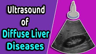 Hepatorenal Syndrome  causes pathophysiology and mechanism [upl. by Ilaw]