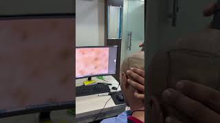 Trichoscopy before hair transplant [upl. by Acirederf]