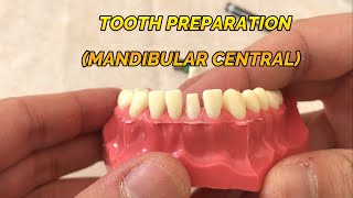 CROWN PREPARATION TUTORIAL MANDIBULAR CENTRAL [upl. by Sammons224]