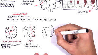 Colorectal Cancer  Overview [upl. by Ahseirej]