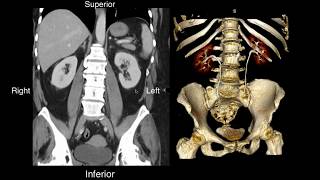 Normal Renal Anatomy [upl. by Yahsel]