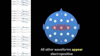 EEG Montages [upl. by Naarah]