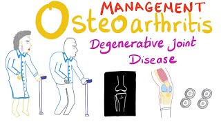 Understanding Treatment Options for Osteoarthritis OA  Johns Hopkins Rheumatology [upl. by Pickar529]