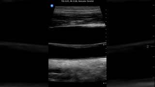 Common Carotid Artery Internal Jugular Vein Butterfly iQ Clinical Image [upl. by Lorollas]