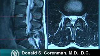 How to Read a MRI of a Lumbar Herniated Disc  Lower Back Pain  Colorado Spine Surgeon [upl. by Sirronal]