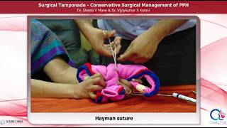 Surgical Management of PPH by Dr Sheela Mane [upl. by Adiene233]