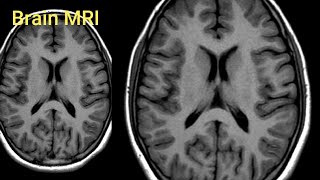 Normal BRAIN MRI image [upl. by Walford]