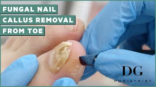 Fungal Nail Treatment And Callus Removal  The Foot Scraper DG Podiatrist [upl. by Bathulda]