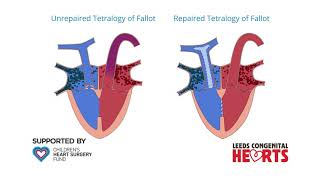 Tetralogy of Fallot [upl. by Lorollas]