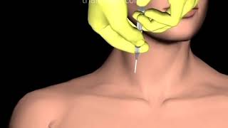 Internal Jugular Vein IJV Access in Hypovolemic Patient Animation by Cal Shipley MD [upl. by Pizor]