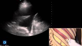 3D Lehrvideo Ultraschallgestütze Thoracentesis Untersuchung  SonoSite Ultraschall [upl. by Cigam752]