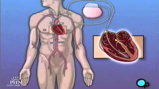 How Do Cochlear Implants Work [upl. by Burnard333]