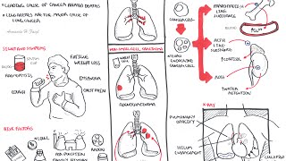 Lung Cancer  Overview [upl. by Eenal334]