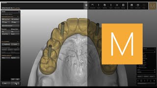 Occlusally screwed bridges module of ZirkonzahnModellier  ZirkonzahnSoftware [upl. by Annert]
