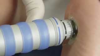 Shockwave Therapy or ESWT Explained [upl. by Ahsietal]