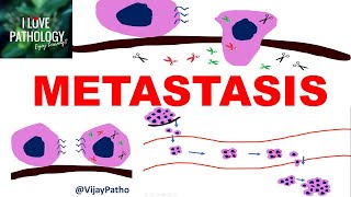 NEOPLASIA 8 INVASION AND METASTASIS Mechanisms Pathways of Spread [upl. by Aicen]