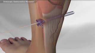 Endoscopic Gastrocnemius Recession [upl. by Ahsena]