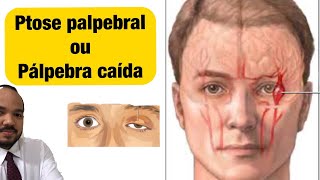 Pálpebra Caída Ptose palpebral pode ser Aneurisma Cerebral [upl. by Inajar]