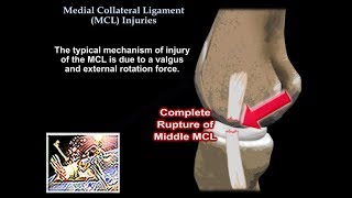 Medial Collateral Ligament Injuries  Everything You Need To Know  Dr Nabil Ebraheim [upl. by Ahsinan]