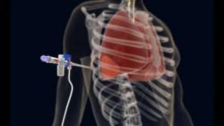 How to make a Thoracentesis pleural puncture with Pleurasafe [upl. by Ku154]