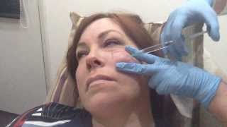 Cheek Augmentation with Juvederm Volift [upl. by Eyma]