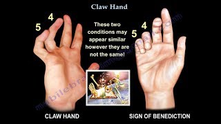 Claw Hand Ulnar Claw Hand  Everything You Need To Know  Dr Nabil Ebraheim [upl. by Drwde]