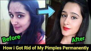 How to Remove Pimples Acne Pimple Marks completely  ThatGlamGirl [upl. by Adnarem]