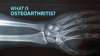 Anatomy of Spine Osteoarthritis [upl. by Jarrid40]