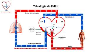 Tetralogy of Fallot TOF – Pediatrics  Lecturio [upl. by Cathy]