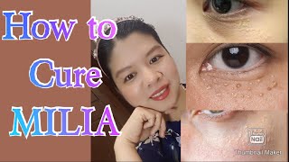 How to cure MILIA at home secret remedy [upl. by Aleen]