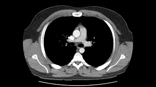 Anatomy of CT scans Thoracic cavity [upl. by Gerry]