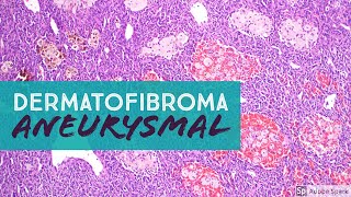 Dermatofibroma Aneurysmal Type Aneurysmal Benign Fibrous Histiocytoma pathology dermpath [upl. by Hutson926]